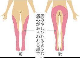 立川駅前ｌ坐骨神経痛ｌ鍼灸指圧マッサージ治療室ホスピターレにお任せください 鍼灸 不妊 美容鍼 治療室ホスピターレ 立川 昭島 日野 八王子