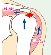 立川ｌ四十肩 五十肩 肩関節周囲炎ｌ治療室ホスピターレ 鍼灸 不妊 美容鍼 治療室ホスピターレ 立川 昭島 日野 八王子